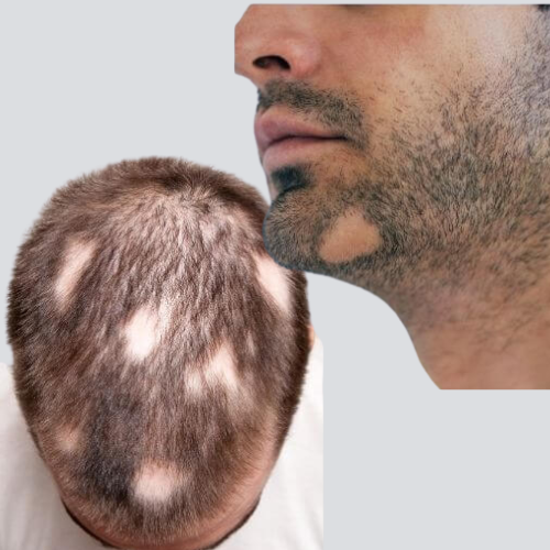 Alopecia hair loss on scalp
