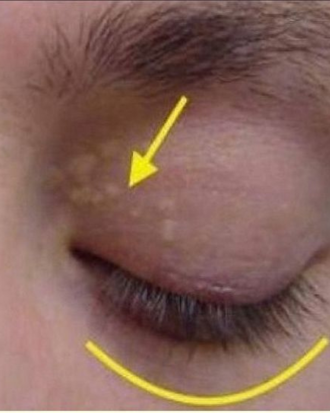 Cholesterol deposit removal