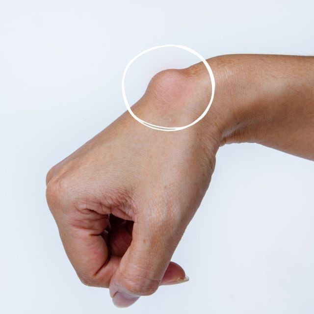 Cyst and lipoma removal procedure