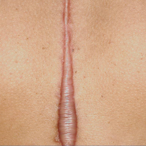 Keloid and hypertrophic scar treatment on shoulder