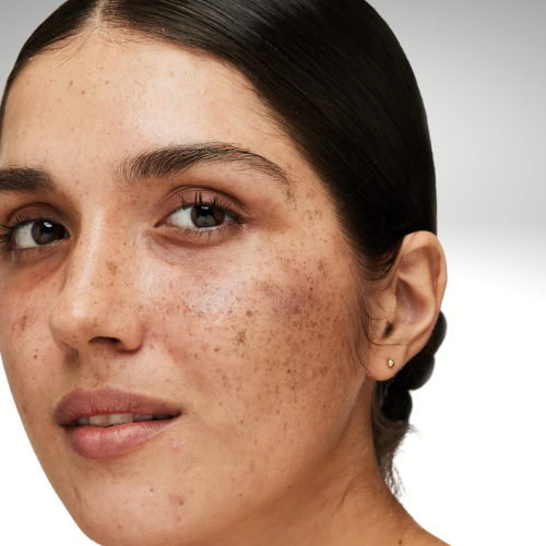 Woman receiving melasma skin pigmentation treatment