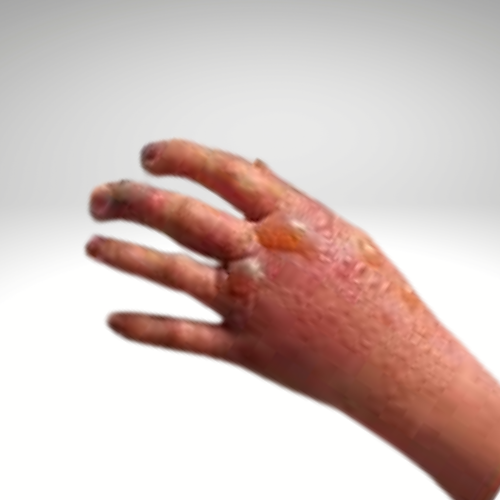 Blistering skin condition Vesiculo-Bullous disease